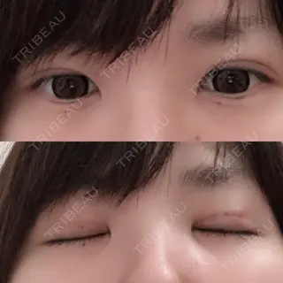 6日目の経過画像（1枚目）