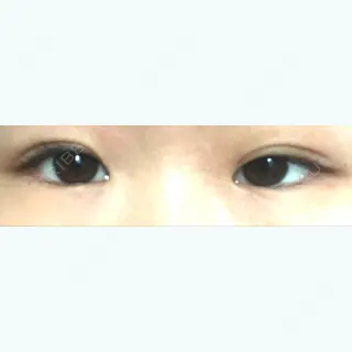 29日目の経過画像（1枚目）