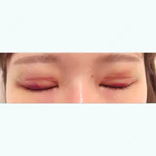 6日目の経過画像（2枚目）