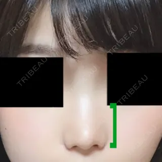 15日目の経過画像（1枚目）