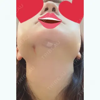 6日目の経過画像（3枚目）