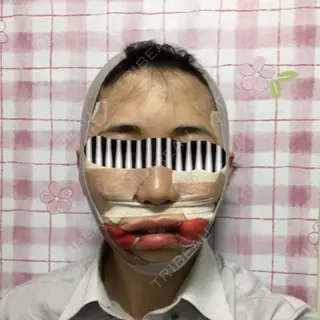 1日目の経過画像（1枚目）
