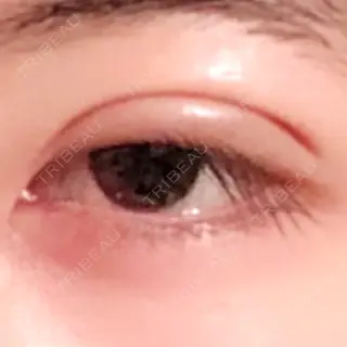 2日目の経過画像（2枚目）