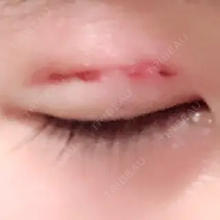 3日目の経過画像（3枚目）