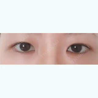 370日目の経過画像（1枚目）