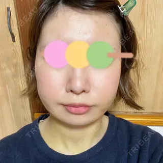 4日目の経過画像（1枚目）