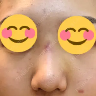 8日目の経過画像（1枚目）