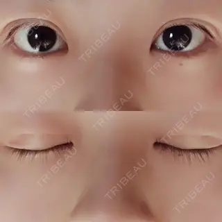 15日目の経過画像（1枚目）