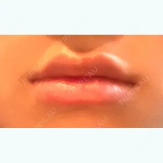 65日目の経過画像（1枚目）