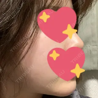 152日目の経過画像（3枚目）