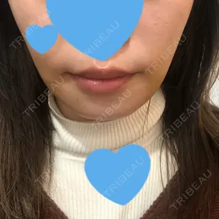 11日目の経過画像（1枚目）