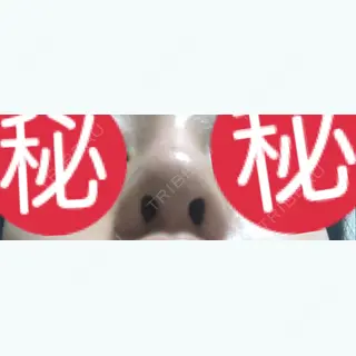 29日目の経過画像（1枚目）