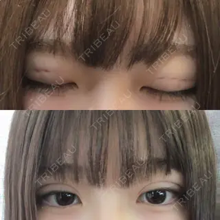 0日目の経過画像（1枚目）