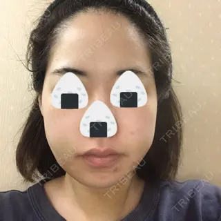 3日目の経過画像（2枚目）