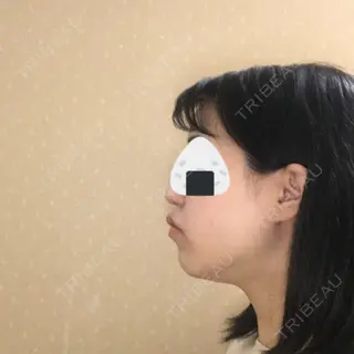 14日目の経過画像（1枚目）