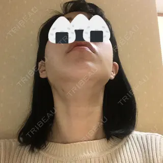 14日目の経過画像（3枚目）