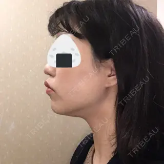 33日目の経過画像（1枚目）