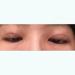 0日目の経過画像（2枚目）
