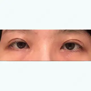 0日目の経過画像（3枚目）