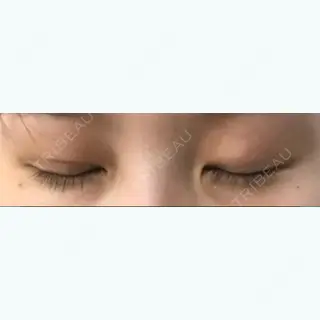 5日目の経過画像（2枚目）