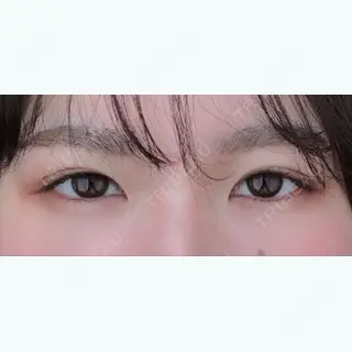 44日目の経過画像（1枚目）