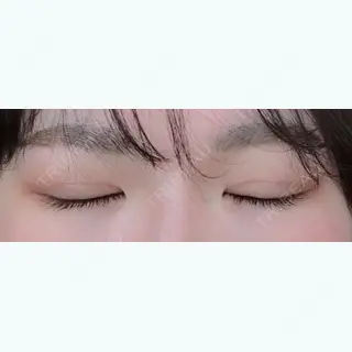 44日目の経過画像（2枚目）
