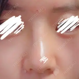 8日目の経過画像（1枚目）