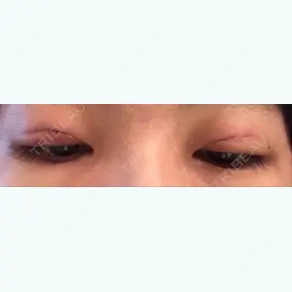 1日目の経過画像（2枚目）