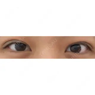 0日目の経過画像（1枚目）
