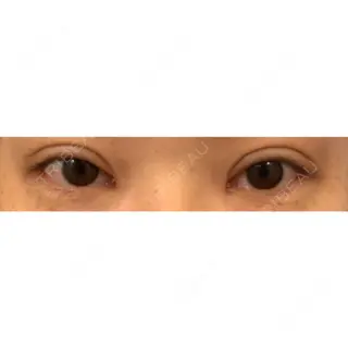 31日目の経過画像（1枚目）