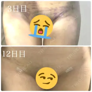 12日目の経過画像（3枚目）
