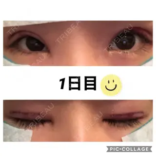 0日目の経過画像（1枚目）