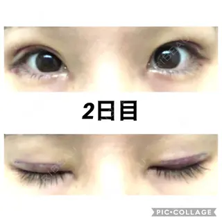 2日目の経過画像（1枚目）