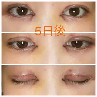 5日目の経過画像（1枚目）