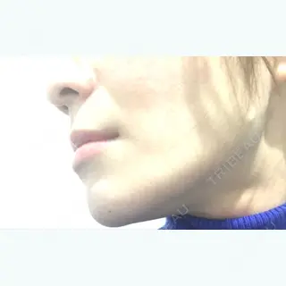 28日目の経過画像（3枚目）