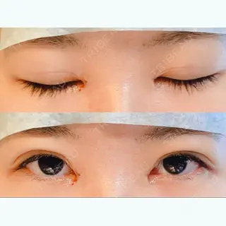 1日目の経過画像（1枚目）