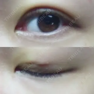 2日目の経過画像（2枚目）