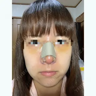 4日目の経過画像（1枚目）