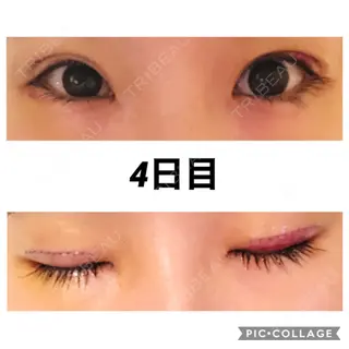 4日目の経過画像（1枚目）