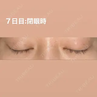 7日目の経過画像（2枚目）