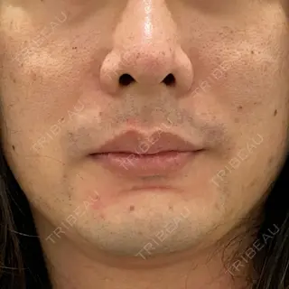 29日目の経過画像（1枚目）