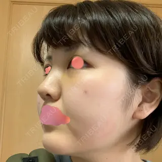 7日目の経過画像（2枚目）