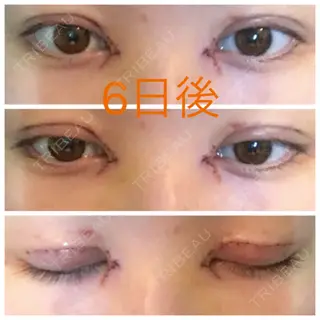 6日目の経過画像（1枚目）