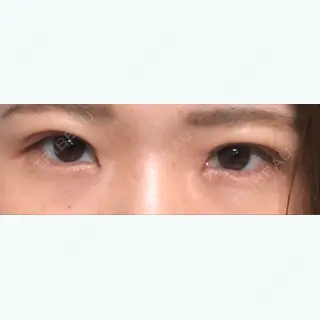 11日目の経過画像（1枚目）