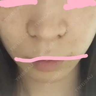 5日目の経過画像（1枚目）