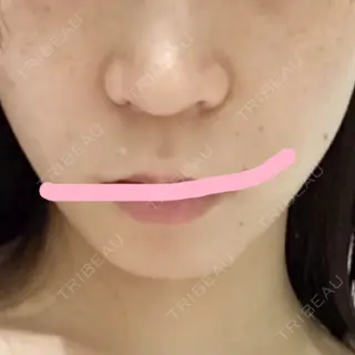 8日目の経過画像（1枚目）