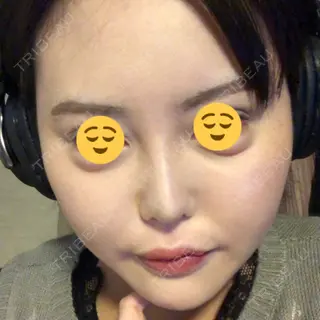 6日目の経過画像（2枚目）