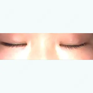 35日目の経過画像（3枚目）