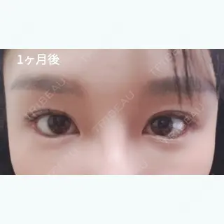 30日目の経過画像（1枚目）