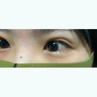 0日目の経過画像（2枚目）